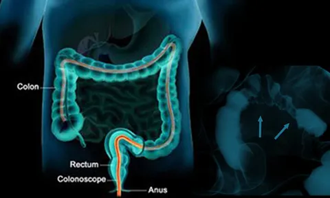 มะเร็งลำไส้ใหญ่ภัยซุ่ม หากเมื่อไหร่มีอาการแสดงว่าเป็นมากแล้ว