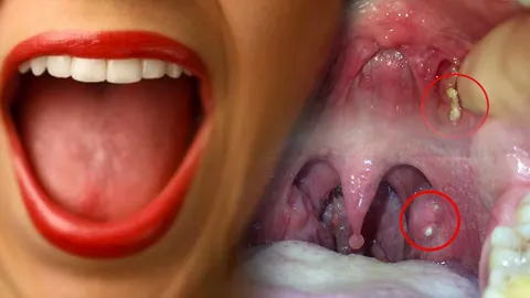 เชื่อดิคุณก็มี! ก้อนสีเหลือง เหม็นเน่า ทำปากเหม็น รู้หรือไม่ ‘ขี้’ อะไรอยู่ในคอ?  