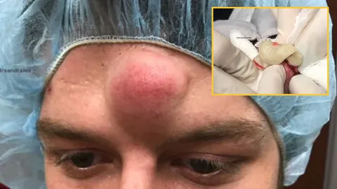 นึกว่าเขายูนิคอร์น! ชมคลิป หมอ เฉือน โคตรสิว ออกจากใบหน้าคนไข้