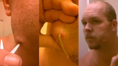 น้ำหนองไหลเยิ้ม! ชมคลิป หนุ่มทนเจ็บไม่ไหว ใช้กรรไกรเจาะฝี หมอเตือนอันตราย