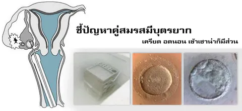 ชี้ปัญหาคู่สมรสมีบุตรยาก เครียด อดนอน เข้าเซาน่าก็มีส่วน