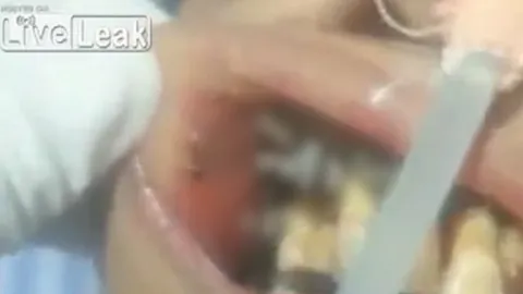 หมอฟันช็อก! ทำฟันหญิงอินเดียเจอหนอนแมลงไชเต็มปาก (คลิป)