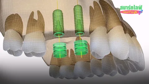 นวัตกรรม..คอมพิวเตอร์ ฝัง "รากฟันเทียม"