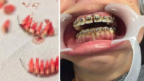  สยองหนักมาก! หมอเผยภาพฟันร่วงยกแผง ภัยร้าย 'ดัดฟันแฟชั่น'