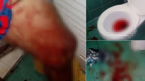 ภาพสยอง! ร้องว้าย หนุ่มฉีดน้ำมันมะกอกเพิ่มขนาดเจ้าโลก เลือดไหลเป็นทาง