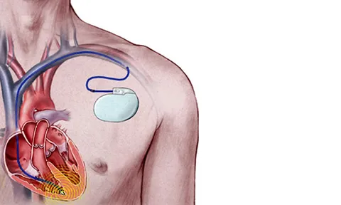 เมื่ออุปกรณ์อิเลคทรอนิคทำงานแทนหัวใจ