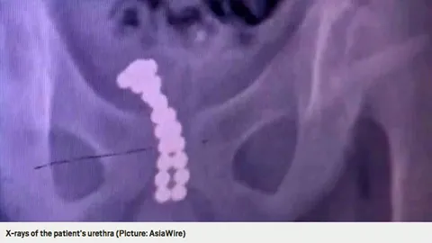 ตี๋จอมซนยัดแม่เหล็กเข้ารูเจ้าโลก