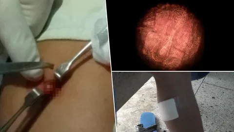 หามหนุ่มเปิบลาบหมูดิบ ส่ง รพ. ตรวจชิ้นเนื้อน่อง เจอพยาธิฝังตัว