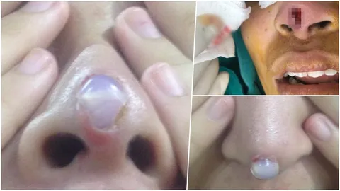 อย่าฝืนธรรมชาติจนเกินไป! เพจดังเตือนคนชอบงัดดั้ง ระวังซิลิโคนทะลุจมูก