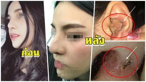 คลินิกดัง ทำสาวสวยจมูกพัง เน่าหนองเยิ้ม..ตะลึง! เซเลบเน็ตไอดอล รีวิวแน่น