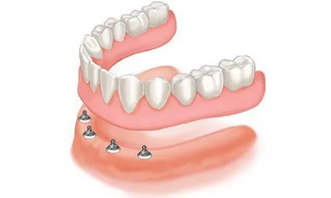 วงการทันตกรรมคิดค้นรากฟันเทียมโฉมใหม่