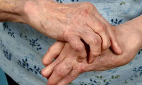 "รูมาตอยด์" ควบคุมได้ถ้ารักษาถูกจุด ระวัง!ยาชุดยาลูกกลอนเร่งพิการเร็วขึ้น