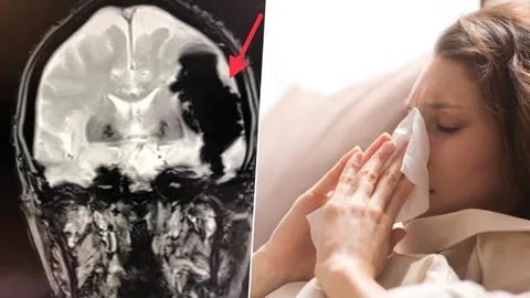 อันตราย! หมอเตือน อย่าบีบจมูก-เม้มปากเวลาจาม ชี้อาจทำให้ลมเข้าสมอง