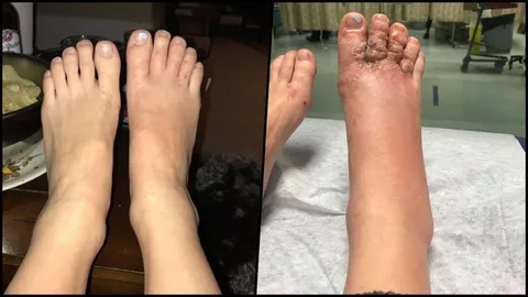 สยอง คู่รักแคนาดาเดินหาดโดมินิกัน เจอพยาธิไชเท้าบวมเป่ง!