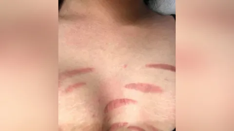 อยากขาวต้องดู! สาวแชร์อุทาหรณ์ทาแล้วผิวแตกลาย คนขายปัดความรับผิดชอบ