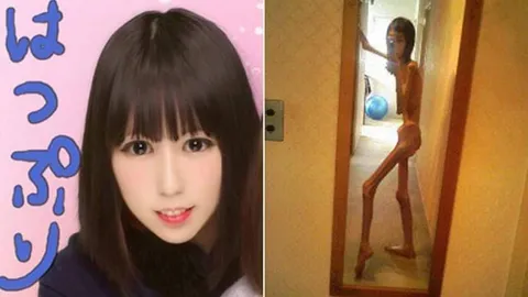 สาวญี่ปุ่นเผยอดีตอันโหดร้าย! ปู่บังคับอดอาหาร ผอมแห้งเหลือแต่กระดูก