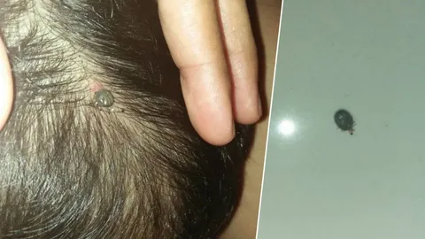 ภัยใกล้ตัว! สาวโพสต์ เตือนคนรักสัตว์ ระวัง 'เห็บรถถัง' ขึ้นหัวลูก