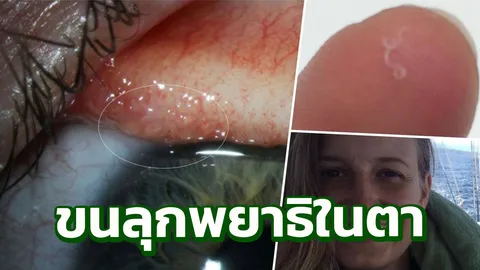 ขนลุก! สาวมะกันเจอพยาธิดิ้นยุบยับในตา ติดจากแมลงวันรายแรกของโลก