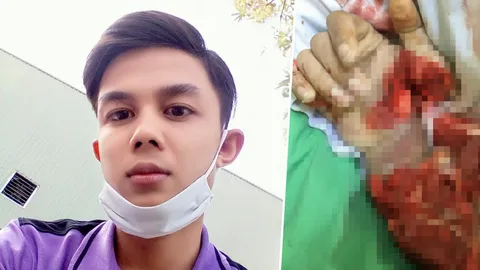 หนุ่มพ้อเสียแขนขวาจากเครื่องจักร 2 เดือน อ้างโรงงานไร้ค่าทำขวัญเยียวยา