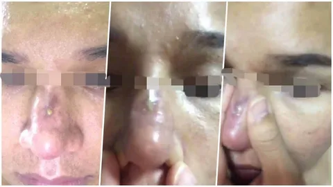 ต้องศึกษาให้ดี! หนุ่มเล่าประสบการณ์ ชีวิตเกือบพังเพราะ 'ศัลยกรรมจมูก'