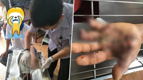 อย่าใช้ของปลอม! หนุ่มรับสาย ขณะชาร์จแบต นิ้วกระจุย ระเบิดคามือ