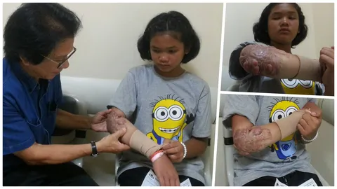 ช่วย ‘น้องแพร’ ตกกระทะตอน 2 ขวบ หมอรามาฯ ผ่าตัดแผลเป็นปูดโปน