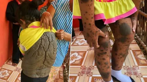 'น้องนิ่ม' เด็กหญิงวัย 13 ปานดำคันลามทั่วตัว ฐานะยากจนวอนคนช่วยเหลือ