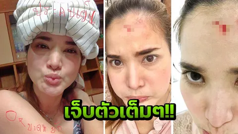 อดีตนางร้ายดัง โชว์แผลสยอง! อุบัติเหตุชนตู้เสาไฟฟ้า