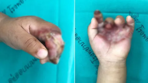 หายไม่ทันใจ! แม่พาลูกโดนน้ำร้อนลวกหาหมอชาวบ้าน พ่นน้ำลายรักษาจนแผลเน่า