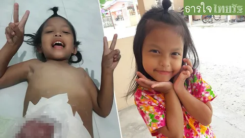 ‘น้องเนเน่’ วัย 7 ขวบ ลำไส้ผิดปกติต้องขับถ่ายทางหน้าท้อง ซ้ำมีภาวะไตวาย