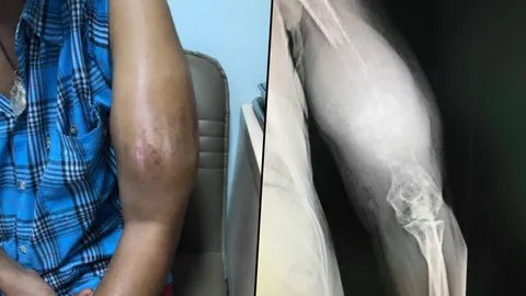 รักษากับหมอบ้าน! คนไข้ตกที่สูงนวดน้ำมันแขน 3 เดือนไม่หาย พบมะเร็งกระดูก
