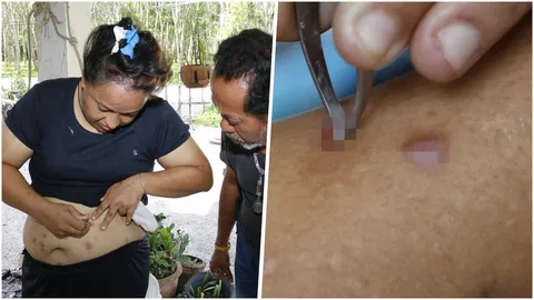 สุดเวทนา! สาวตรัง ป่วยประหลาด ตุ่มใส 'แมลงคล้ายหนอน' โผล่ ไชผิวหนัง 