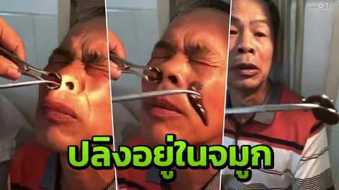 สยอง! ชายจีนเลือดกำเดาไหลบ่อย หมอคีบปลิงตัวเขื่องออกจากรูจมูก (คลิป)