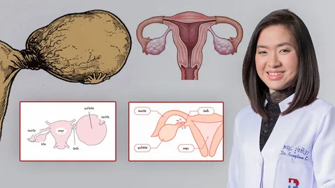 "เดอร์มอยด์ ซีสต์" ปล่อยไว้อันตราย...ถึงขั้นตัดรังไข่ทิ้ง