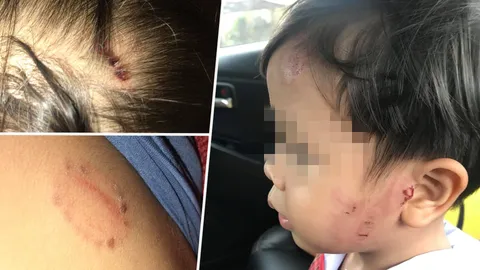 พี่ฉุน! น้อง 4 ขวบถูกทำร้ายบาดเจ็บ แต่ครูบอก ถ้าแจ้งความ ร.ร.ไม่ประกัน