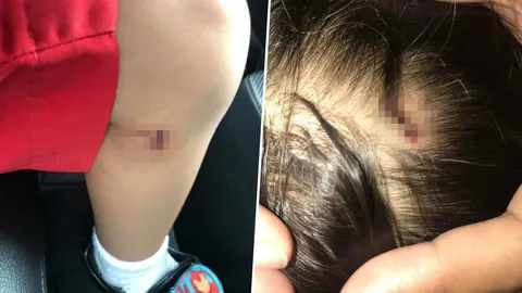 ลงโทษครู-โรงเรียน ต้นสังกัด 4 ขวบ ถูกทำร้ายเจ็บ เร่งเยียวยาเด็ก