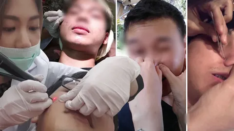 คนแห่ดูเป็นล้าน! รวมคลิปกดสิว ทั้งบีบ ทั้งเค้น เจ็บแค่ไหนก็ทนได้