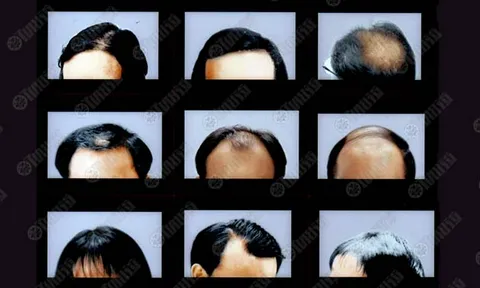 ช่วยเหลือคนมีผมน้อย ทั่วทั้งโลกได้แล้ว เซลล์ต้นกำเนิด ปลูกผม