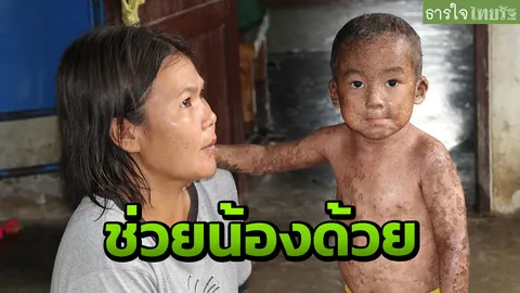 วอนผู้ใจบุญช่วย น้องพอร์ช ที่ราชบุรีวัย 2 ขวบ ป่วยเป็นเด็กดักแด้ 