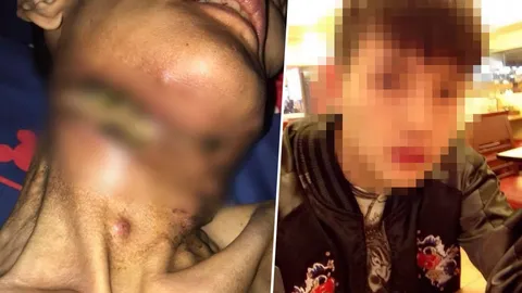 แค่เผลอกัดลิ้น! หนุ่มป่วยมะเร็ง ต่อมน้ำเหลืองแตก คอเกือบขาด