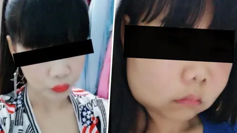 แพงไม่ปัง พังก็มี! ฉีดฟิลเลอร์เกาหลีทำพิษ สาวติดเชื้อหน้าบวม ตาเกือบปิด