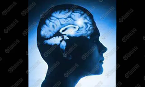 เจาะน้ำไขสันหลังตรวจ รู้โรคสมองเสื่อม ก่อนหน้าหลายปี