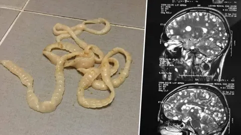 คนตื่นพยาธิตัวตืด! หมอแนะอย่าซื้อยากินเอง เสี่ยงไข่ย้อนกลับปล่อยตัวอ่อนชอนไช