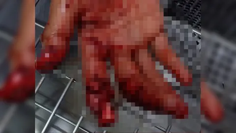 อีกแล้ว! ด.ช.วัย 13 จุดประทัดลูกบอลระเบิดคามือนิ้วชี้ขาด 1 ข้อ