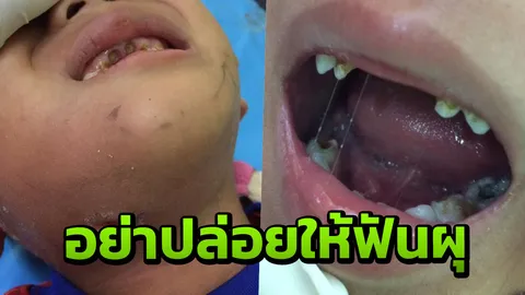 อุทาหรณ์สอนพ่อแม่! ฟันผุไม่ใช่เรื่องธรรมดา พบเคสผุทะลุโพรงประสาทฟัน