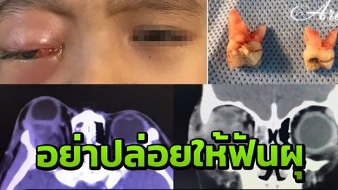หมอพบคนไข้ตาอักเสบจนปูดโปน เหตุติดเชื้อที่ฟันผุ ลุกลามจนเป็นหนอง