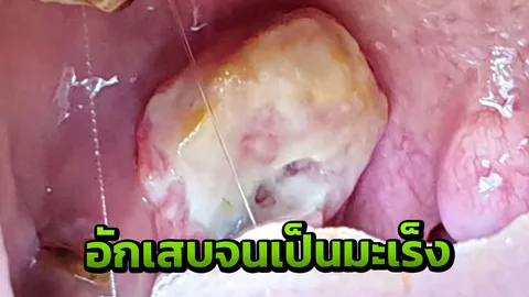 หนุ่มใหญ่พบต่อมทอมซิลโต มีแผลเล็กๆ ลุกลามจนเป็นมะเร็งแค่เพียง 1 เดือน