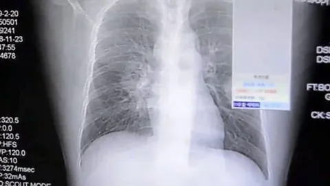 ติดสูดดมถุงเท้าจนปอดพัง