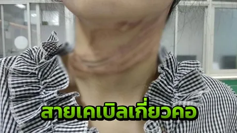 สาววัย 20 ถูกสายเคเบิลเกี่ยวคอขณะขี่มอเตอร์ไซค์ 3BB รับผิดพร้อมดูแลชดใช้
