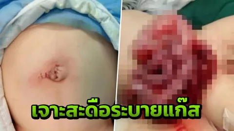 ทารกจีนไส้ทะลักเกือบตาย พ่อเห็นสะดือนูนผิดปกติเลยเจาะหวังระบายแก๊ส